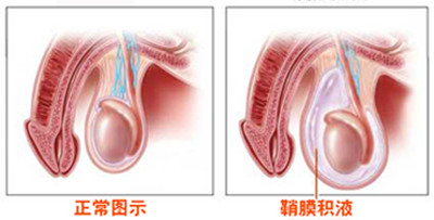 男性如何得知患有鞘膜积液